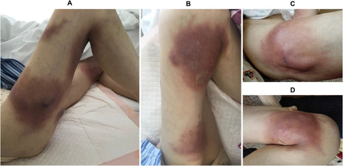 Figure 1 Physical examination of the female patient diagnosed as mediastinal small cell carcinoma complicated with primary cutaneous cryptococcosis. Multiple painful skin lesions with erythema and swelling on both thighs (A and B). Abscesses on both thighs (C and D).