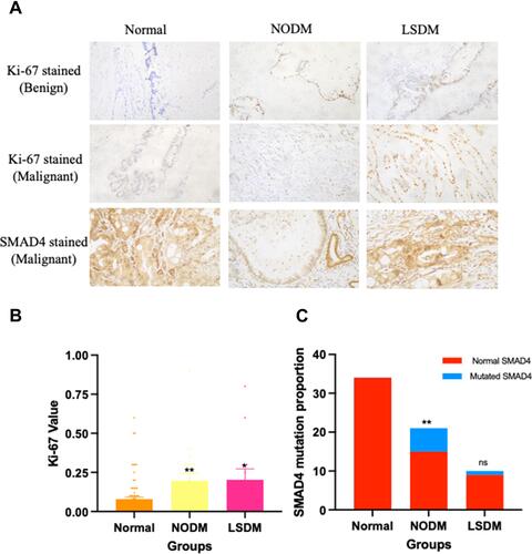 Figure 1 The Ki-67 and SMAD4 expression in PCN patients. (A) The immunohistochemistry plot of Ki-67 and SMAD4 in PCN surgical samples (Left three plots: samples from the normal group; middle three plots: samples from the NODM group; right three plots: samples from the LSDM group). The upper three plots were the Ki-67 level (the brown dots) in benign PCN patients. The middle three plots were the Ki-67 level (the brown dots) in the malignant PCN patients. The lower three plots were the SMAD4 expression level (the brown dots) in the malignant PCN patients. (B) The conclusive histogram of the Ki-67 in the normal group, the NODM group and the LSDM group. The NODM and the LSDM group showed a significant elevation in Ki-67 value compared with the normal group (**P<0.01; *P<0.05). (C) The conclusive SMAD4 mutation proportion in three groups. The red bar represents the samples without SMAD4 mutation while the blue bar symbolizes the SMAD4 loss mutation in the NODM and the LSDM group. The NODM group showed a statistical increase in SMAD4 mutation than the normal group (**P<0.01), but the LSDM group showed no statistical difference from the normal group in SMAD4 mutation (ns: P>0.05).