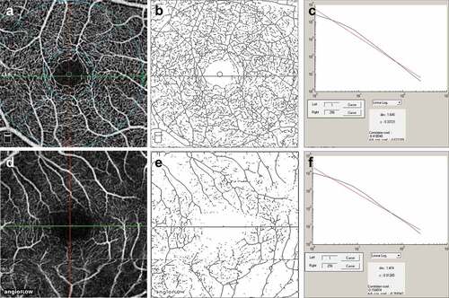 Figure 1. The figure shows calculation of the fractal dimension (FD) of the superficial retinal capillary plexus on en face optical coherence tomography (OCTA) in a normal subject (a-c) and a patient with posterior uveitis (healed) (d-f). The superficial plexus of the normal subject on OCTA is shown in A. The postprocessing skeletonized image is shown in B. The FD graph is depicted in C. The superficial plexus of the patient on OCTA is shown in D. Corresponding skeletonized image and FD graph is shown in E and F.