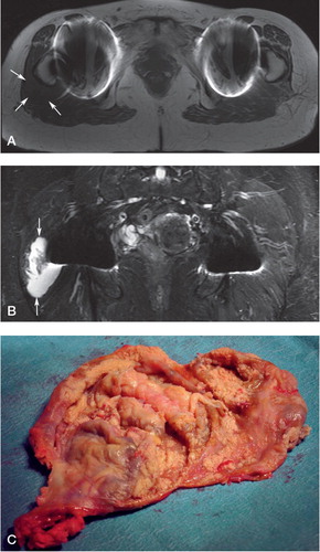 Figure 2. Images from a 64-year-old woman who had undergone total hip arthroplasty of the right hip 4.7 years earlier. She had stiffness and exercise-related pain in the replaced right hip. Whole-blood cobalt was 6.9 ppb and chromium was 4.8 ppb (normal reference values are < 0.8 ppb for Co and Cr). A thick-walled pseudotumor with solid content was seen extending posterolaterally from the hip joint region on the right side. Variable signal intensity was seen in axial T1 (panel A). Synovial hypertrophy was best seen in coronal STIR view (B). A mixed-type pseudotumor with thick walls and partially solid contents was seen at revision surgery (C).