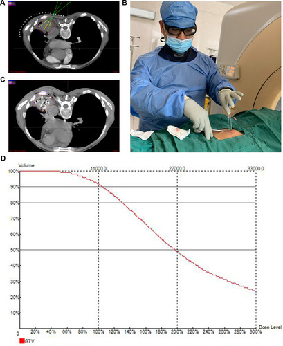 Figure 2 The treatment procedure. (A) Design of the preoperative plan, lines of different colors stand for different dose which was delivered to the primary tumor. (B) Course puncturing (C) The practical distribution of iodine −125 seed. (D) postoperative dose volume histography of tumor.