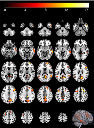 Figure 2 Significantly different brain regions of seed-based functional connectivity between hippocampus and whole brain among the three groups. zFCs increased between hippocampus and the brain regions marked with color, and there were no regions with reduced FC. After FWE correction, the voxel P<0.001 and cluster P<0.05.