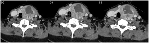 Figure 1. Contrast-enhanced CT images for a representative case involving a 49-year-old woman with a benign follicular nodule in the left thyroid gland prior to treatment. CT-based measurements of the (a) tracheal deviation distance, (b) ratio of anteroposterior/transverse diameter of the trachea, and (c) anterior neck angle.