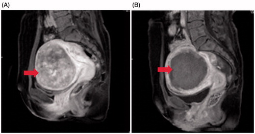 Figure 3. Contrast-enhanced MR images obtained from a patient with an anteverted uterus. (A) A pre-procedure contrast-enhanced MR image showed a 8.0 × 6.8 × 6.7 cm fibroid located at the anterior wall of the uterus (arrow). (B) Contrast-enhanced MRI obtained 1 day after HIFU showed the non-perfused volume ratio was 91% (arrow).