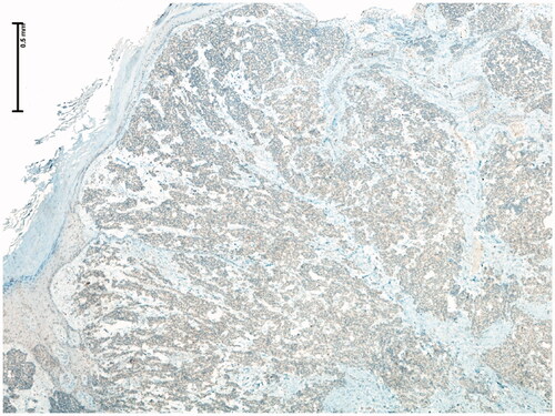Figure 6. Low magnification microscopic photograph (4× IHC) showing complete negativity for TTF-1.