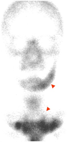 Figure 4 Bone scintigram (99mTc-labeled methylene diphosphonate) at first visit, showing extremely intense tracer uptake in the left side of the mandible, the sternum, and the sternocostal and sternoclavicular joints.