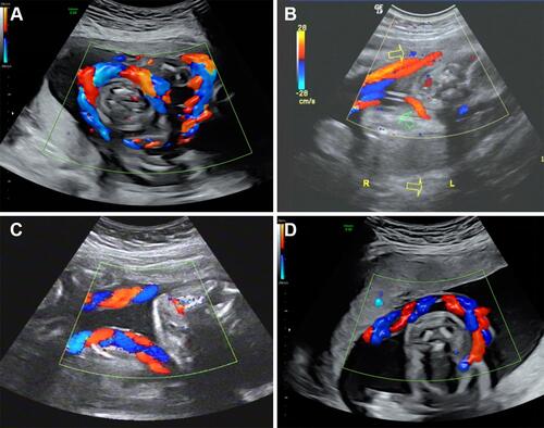 Figure 3 (A) α-shaped type: LOA position, right Figure shows the spine in the right front, the umbilical cord coils from left to right, left Figure shows the umbilical cord crossing the chest and entering the anterior wall of placenta, the coiling angle is >360°; (B) O-shaped type: The blood flow of the umbilical artery is in the direction of the arrow, the yellow arrow is the proximal end of the umbilical cord, and the green arrow is the distal end of the umbilical cord, the coiling angle is 360°; (C) C-shaped type: LOA position, the spine is on the left side, it can be seen that the umbilical cord coils from right to left, the distal end enters the posterior wall of placenta, the two ends of the umbilical cord are far away from each other and are hung in the neck like a scarf; (D) L-shaped type: LOA position, the spine is on the right side, the umbilical cord runs from the right anterior wall of the placenta through the left side of the fetal neck, the umbilical artery blood flow is blue, it represents the direction of the umbilical cord from the chest to the back.