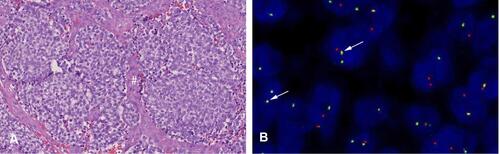 Figure 2 Tumor pathology. (A) Hematoxylin and eosin (HE) stain x20 magnification, demonstrating uniform small round cells with fine dispersed chromatin with only sparse cytoplasm. The tumor cells are arranged in noduli with intervening lighter fibrovascular bands (#). (B) Fluorescence In Situ Hybridization (FISH). Dual color break apart probe with the red fluorochrome direct proximal of the EWSR1 gene while the green direct distal to the gene. In normal cells you will see two yellow signals (red/green), but in this case there is only one normal yellow signal and a split red and green signal (marked with arrows). Thus there is a translocation affecting the 22q12.1 – q12.2 (the EWSR1 gene).