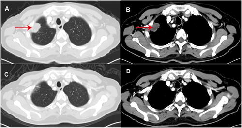 Figure 2 (A and B) Thoracic CT scan detected a subpleural soft tissue mass in the right upper lung (red arrows); (C and D) after 4 weeks of treatment with afatinib, a thoracic CT scan showed a diminished subpleural tumor in the right upper lung.