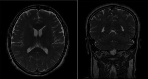 Figure 3. Brain MRI transverse and coronal plane.