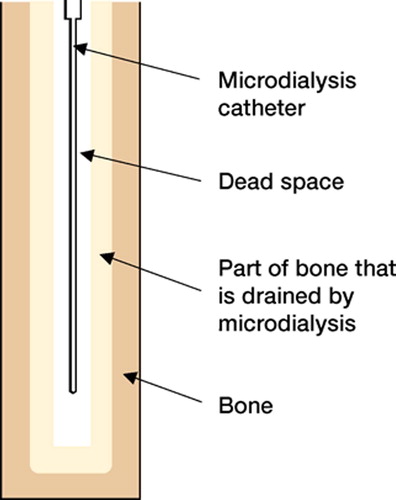 Figure 3. Drawing of the catheter used for microdialysis, placed in bone. The light gray area is the part of the bone from which the metabolites diffuse. The area around the catheter is the dead space, from which the metabolites diffuse into the catheter.