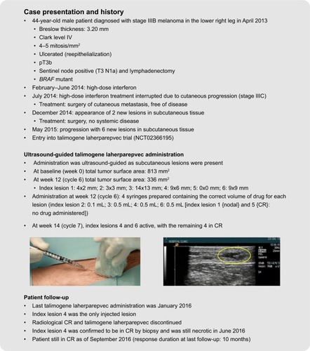 Figure 5 Case studies demonstrating standard and ultrasound-guided administration of talimogene laherparepvec. The yellow oval indicates the injected lesion under ultrasound guidance. The patients provided written informed consent for the publication of the case details and any accompanying images.