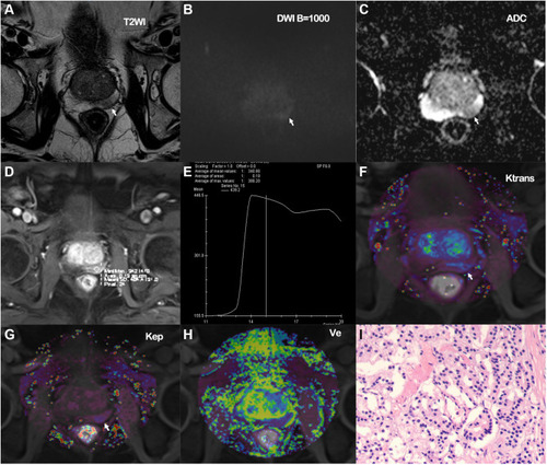Figure 1 A 56-year-old male presenting with urological symptoms such as frequent/urgent micturition. (A) The T2-weighted images showing lower signal intensity in parts of the left lobe of the prostate; (B) the diffusion-weighted imaging (b-value = 1000 s/mm2), showing a somewhat higher signal intensity; (C) the apparent diffusion coefficient map showing somewhat lower signal intensity; (D) the dynamic contrast-enhanced scan delineating the region of interest; (E) the signal–time curve, presenting the outflow type; (F–H) the Toft pharmacokinetic model quantitative analysis of the dynamic contrast-enhanced magnetic resonance imaging transfer constant, rate constant, and the volume of the extravascular extracellular space, presented as pseudocolored images. (I) the needle biopsy pathology report suggesting prostate acinar adenocarcinoma; Gleason score, 3 + 4 = 7.