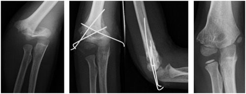 Figure 5. A. AP elbow radiograph of a 6-year-old boy with Gartland grade-III extension-type supracondylar fracture. B. Malunion at 3 weeks after unsatisfactory reduction and pin fixation in AP and sagittal planes. C. Corrective osteotomy was scheduled 3 years later after 7 postoperative radiographs.