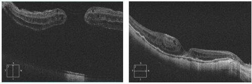 Figure 2 Left, pre-operative SD-OCT image in a 5-line raster scan mode of the right macula of a 62-year old female patient. Note the central retinal detachment and full-thickness macular hole. The axial length of the right eye measured 26.3 mm. Right, corresponding post-operative SD-OCT image in a 5-line raster scan mode. The patient had retinal re-attachment and U-type closure of the macular hole. Note the sub-foveal residual neuro-sensory retinal detachment and para-foveal cystoid changes. There is posterior bowing of the globe and significant thinning of the choriocapillaris, which are consistent with high myopia. Her final BCVA was 0.2 decimal units.