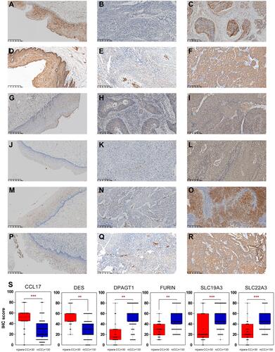 Figure 5 IHC for CCL17, DES, DPAGT1, FURIN, SLC19A3 and SLC22A3. CC-adjacent tissue (N=30) and CC tissue (N=130) samples. CC-adjacent tissue samples with weak immunostaining scores for DPAGT1 (G), FURIN (J), SLC19A3 (M), and SLC22A3 (P) and strong immunostaining scores for CCL17 (A) and DES (D). CC samples with weak and strong immunostaining scores for CCL17 (B and C), DES (E and F), DPAGT1 (H and I), FURIN (K and L), SLC19A3 (N and O) and SLC22A3 (Q and R). The expression of the CCL17, DES, DPAGT1, FURIN, SLC19A3 and SLC22A3 genes is depicted in S slides (X 100). **p < 0.01, ***p < 0.001.