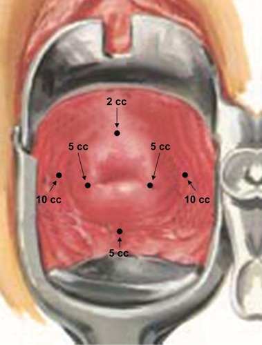 Figure 1 Para/intracervical block injection sites.