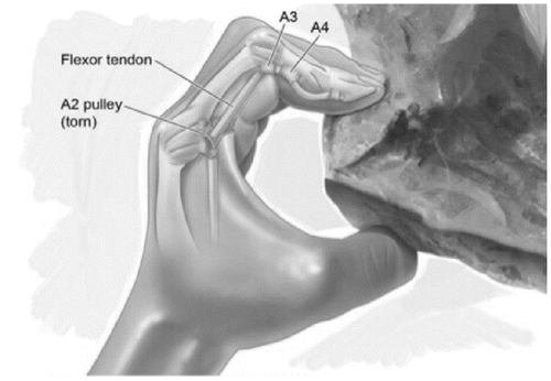 Figure 1. Example of climbing specific hand injury due to the unique anatomical stress of climbing. The “crimp” position handled puts stress on the A2 pulley of the finger.