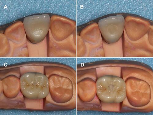 Figure 2 Crown holes filled by composite resin: (A) AMH; (B) ARH; (C) PMH; (D) PRH.