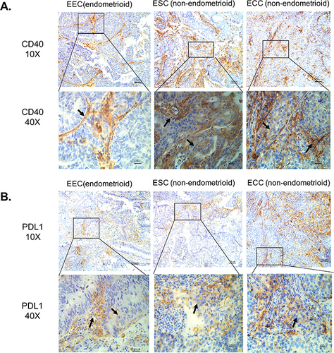 Figure 1 In situ protein expression of CD40 and PD-L1 in different types of endometrial carcinoma. (A) CD40 expression in different types of endometrial carcinoma. (B) PD-L1 expression in different types of endometrial carcinoma. The black tip points to the positive CD40 expression.