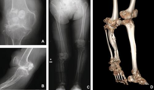 Figure 1 (A) Radiography of the right leg documenting severe bone-on-bone contact and bone bruising. (B) Lateral radiograph of the right knee documenting hyperextension with a severe anterior slope. (C) Anteroposterior radiograph documenting the extent of limb shortening. (D) Three-dimensional computed tomography (CT) scan documenting the tibial deformity and osteoarthritis.