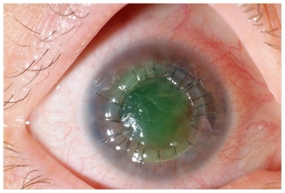 Figure 2 Tectonic/therapeutic corneal graft.
