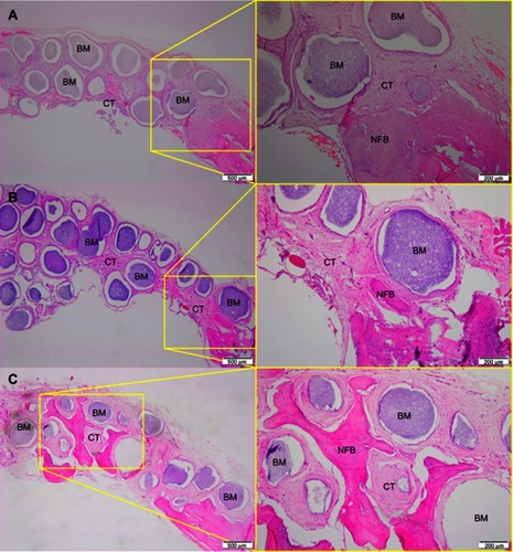 Figure 5 Micrographs of cHA group after 1 (A), 3 (B) and 6 (C) months of implantation, respectively.Notes: Magnification: 10X. The squares indicate the magnified area observed using a 40X objective. BM, Biomaterial; NFB, New Formed Bone; CT, Connective Tissue. Stain: HE.Abbreviations: cHA, carbonated hydroxyapatite; HE, hematoxylin-eosin.
