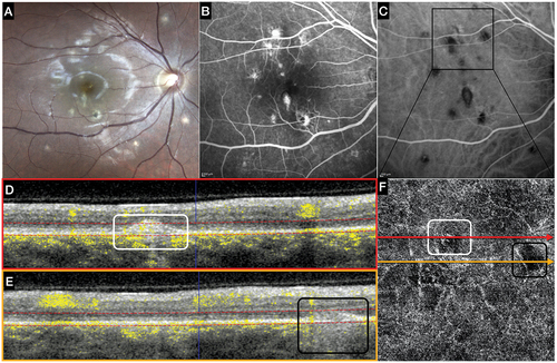 Figure 2. Multimodal Imaging in a patient affected by multifocal choroiditis (MFC) with multiple active lesions.