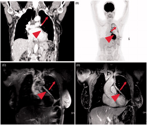 Figure 1. Images in 69-year-old woman with a newly diagnosed left-sided malignant pleural mesothelioma (epithelioid histology). (a and b): Coronal CT (a) and FDG-PET (b) show a diffuse pleural thickening with diffuse FDG-avid zones, with the exception of a portion of parietal pleura indicated by the arrows (in a and b). (c and d): T2-weighted SPAIR image (c) and contrast-enhanced T1-weighted VIBE image (d) show a possible mesothelioma deposit along the whole lateral pleural surface (arrow in c and d): the region that was negative on the CT (a) and FDG-PET (b) appears to be hyperintense in c and d. Moreover, in c and d the pericardium is hyperintense (arrowhead in c and d), while in a and b is slightly thickened and the FDG-avidity is not clearly visible.