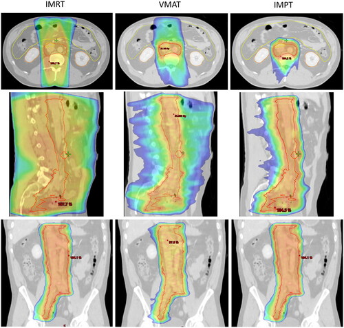 Figure 2. Dose distribution for CTV-E shown for IMRT, VMAT and IMPT. Top row: Transversal view; Middle row: Sagittal view; Bottom row: Coronal view. Shown is the 50% dose colour wash.