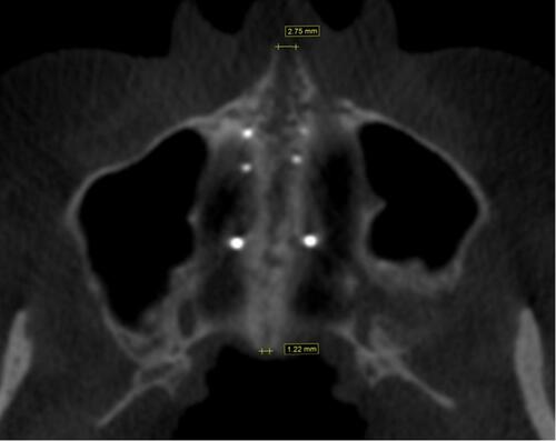 Figure 17 Axial palatal section on patient CBCT after maxillary expansion.