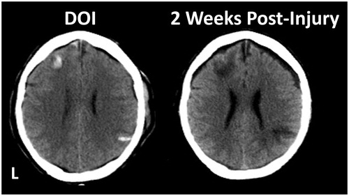 Figure 2. L = Left. The CT image on the left is from the day-of-injury (DOI) and shows focal intraparenchymal haemorrhage in the left frontal lobe with a contrecoup focal haemorrhagic lesion located posteriorly in the right parietal area. By 2 weeks post-injury, focal areas of decreased density deep within the frontal and parietal parenchyma have developed, reflecting damage substantially larger than the original haemorrhagic lesion.