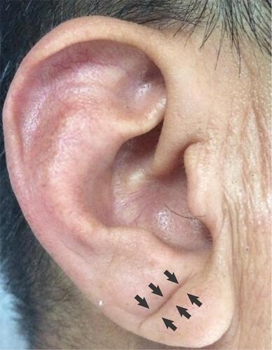 Figure 1 Typical example of the unilateral earlobe crease. The arrow shows earlobe crease.