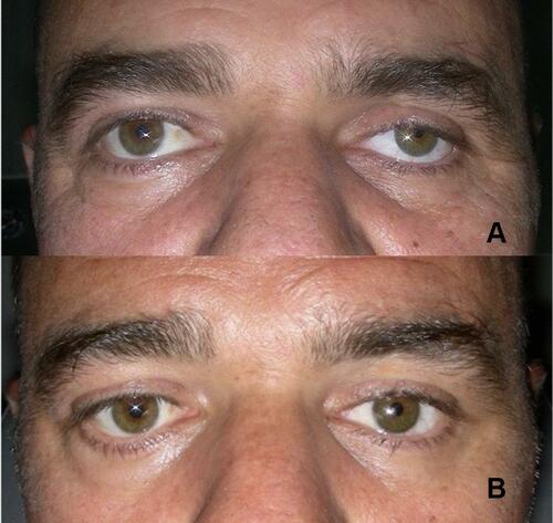 Figure 2 (A) Left orbital volume deficiency post left enucleation with no primary implant. (B) Adequate orbital volume following left secondary ball implantation. (Image is the property of the authors).