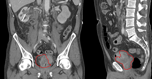 Figure 1 Contrast-enhanced CT urography, coronal (A) and sagittal (L) view of the tumor (encircled with the red line). Left side (A) is showing the tumor extending into the urinary bladder. On the right side (L) the tumor extends into the urinary bladder, prostate and seminal vesicles.
