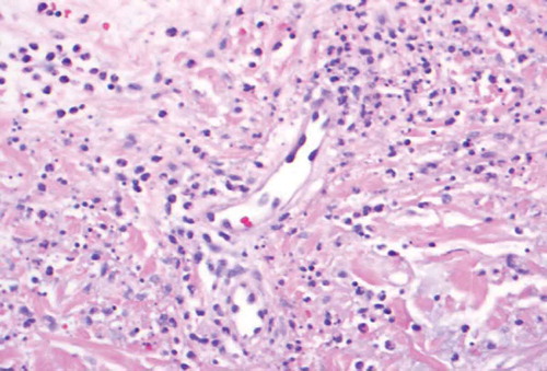 Figure 5. 40X. Neutrophils and nuclear dust in the blood vessel walls causing destruction of the blood vessel walls.