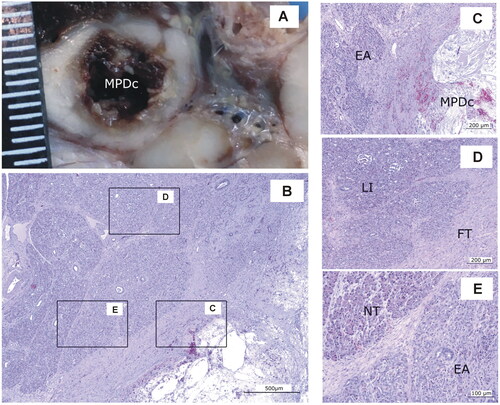 Figure 9. Animal model results. Histopathological findings of Group 7-day. (A) Macroscopic view of the main panreatic duct (MPD) showing a large cavity (MPDc) with irregular brown margins. (B − E) Microscopic image (H&E). (C) Cavity with cellular debris and amorphous material (MPDc), complete exocrine atrophy (EA); (D) Fibrous tissue (FT) Langerhans islets preserved (LI). (E) Lobules with complete or partial exocrine atrophy (EA) and lobules without lesions (NT). Scale in mm.
