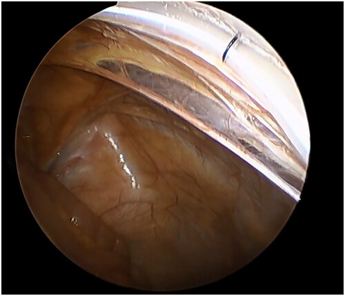 Figure 3. The suture was tightened and the catheter was fixed on the anterior abdominal wall.