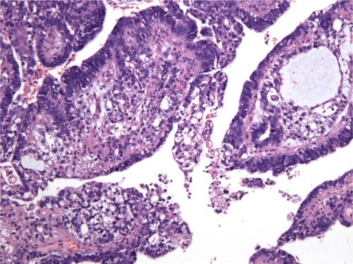 Figure 2 Mixed components: a close transition from the endometrial adenocarcinoma to the yolk sac tumor areas (hematoxylin and eosin, 100×).