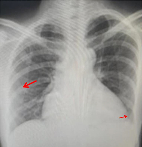 Figure 2 Chest X-ray showing right mid to lower lung coalescing patchy opacities with ground glass change (the red arrow), enlarged cardiac silhouettes (CTR 61%) with rounded right heart border and shift of cardiac apex (small red arrow).