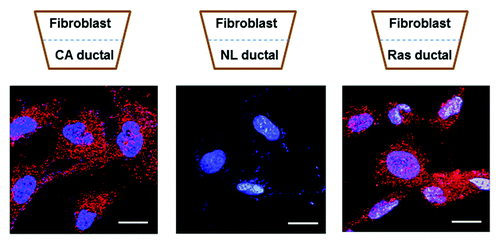 Figure 1. Normal human dermal fibroblasts were grown adjacent to pancreatic ductal cells in a transwell plate. Left: fibroblasts grown adjacent to pancreatic cancer ductal cells caused upregulation of palladin (stained red) in the fibroblasts. Middle: fibroblasts growing adjacent to normal pancreatic ductal cells do not express palladin. Right: k-ras expression (either wild type or mutated k-ras) in a normal pancreatic ductal cell was sufficient to upregulate palladin in the adjacent normal fibroblast. Once fibroblasts express palladin they develop the myofibroblast phenotype. Nuclei are stained blue with DAPI. Scale bars indicate 20 μm.