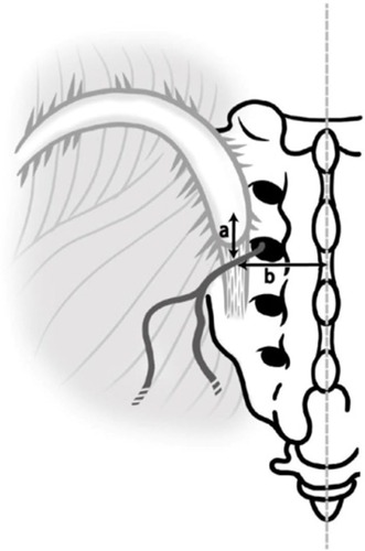 Figure 1 Schematic illustration of measurements of linear distances from the posterior superior iliac spine (distance a) and the midline (distance b) to a branch of the MCN traversing over or under the LPSL.