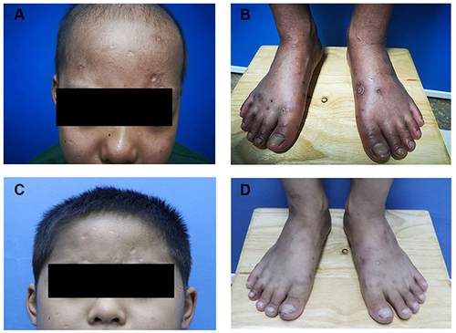 Figure 1 (A–D) papules, necrosis, atrophic scars and depigmentation on the scalp, face, hands, feet were significantly improved after the treatment.