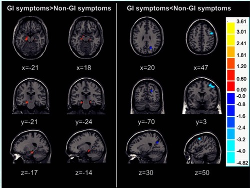 Figure 2 Regional GM volume differences between GI symptoms group and non-GI symptoms group displayed on axial, coronal and sagittal slices. Numbers indicate x, y and z slices and are displayed in MNI coordinates. Red and blue colors denote increased and decreased GM volume. The color bars indicate the T-value based on two-sample t-test. (voxel- P <0.01, cluster- P <0.05, cluster size>50, GRF correction).Abbreviations: GM, gray matter; MNI, Montreal Neurological Institute; GI:  gastrointestinal symptom; GRF, Gaussian Random Field.