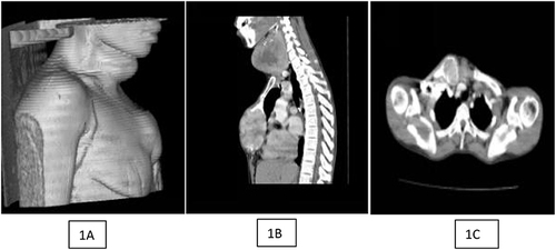 Figure 1 Chest CT scan showing thyroid enlargement with metastatic right clavicular mass and sternal mass. (A) 3D reconstruction (B): Sagittal view (C): Axial view showing right medial clavicular metastatic mass.