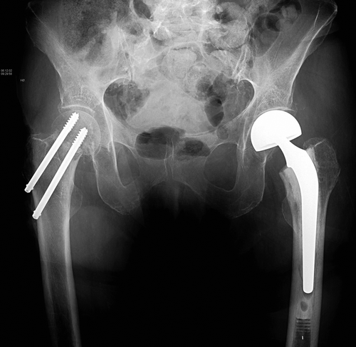 Figure 3. Anterioposterior pelvic radiograph of a patient who has suffered femoral neck fractures on both sides, only a few weeks apart. On the right side she was operated with two parallel screws and on the left side with a hemiarthroplasty.