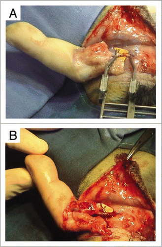 Figure 9 (A) End-to-end arterial attachment of the dominant palmar artery of the finger to the rabbit's carotid artery. (B) Upon release of the arterial clamps, xenograft revascularization was immediate, with appearance of a venous flow-through. However, the finger became rapidly marbled and the capillary pulse was hardly perceptible.