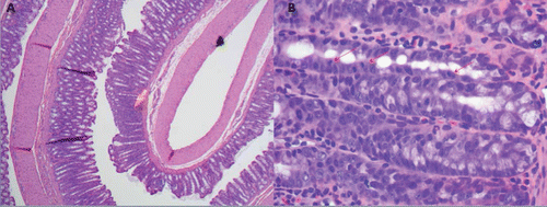 Figure 4. An example of the histological appearance at low and high power of an inflammatory/hyperproliferative focus observed in Study 3. On histologic examination of the colons that had been “Swiss rolled,” the foci were noted by their narrow caliber, mucin, and Goblet cell-depleted crypts (yellow arrow in Fig. 4A), and then by the frequent mitotic figures (red arrows in Fig. 4B), the damaged luminal surface of the aberrant crypt focus, and the many acute and chronic inflammatory cells. The large crypts, so evident on the topologic en face preparation, were not as evident in this histological section.