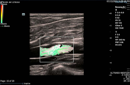 Figure 7 High-frame rate vector flow imaging of the knee was performed to exclude deep vein thrombosis. The image shows normal patency of the popliteal vein with green vector arrows. No thrombosis is found.