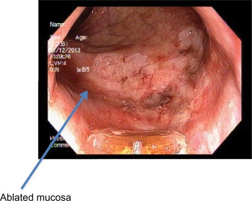 Figure 6 Immediately post-radiofrequency ablation.